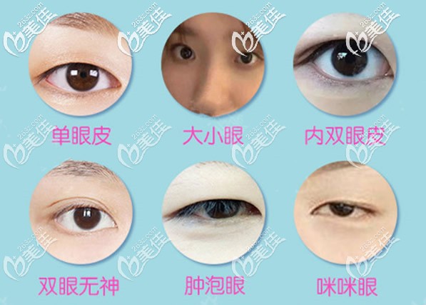割雙眼皮可以改善哪些眼部問題