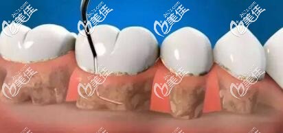 洗牙齦下刮治 洗牙齦下刮治