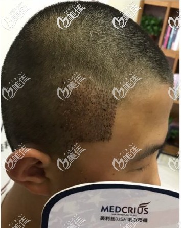 天生鬢角缺失，植鬢角后即刻效果圖