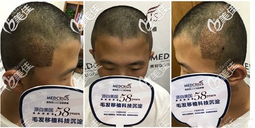他天生缺鬢角，做無痕FUE鬢角植發(fā)后好后悔沒能早點(diǎn)找到這個(gè)解決禿鬢角的辦法!