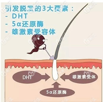 造成雄性脫發(fā)的主要原因 造成雄性脫發(fā)的主要原因