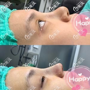 剛做完鼻綜合手術(shù)鼻子是高挺的 剛做完鼻綜合手術(shù)鼻子是高挺的