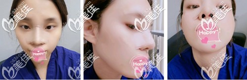 鼻綜合術(shù)后一周鼻子微腫 鼻綜合術(shù)后一周鼻子微腫