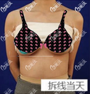 傲諾拉璀璨水滴形假體豐胸拆線后效果