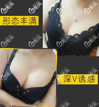 傲諾拉隆胸半年后恢復(fù)圖