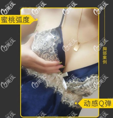 假體豐胸六個(gè)月效果