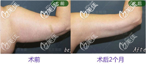 北京韓嘯手臂吸脂真人案例 北京韓嘯手臂吸脂真人案例