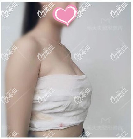 假體隆胸手術恢復期