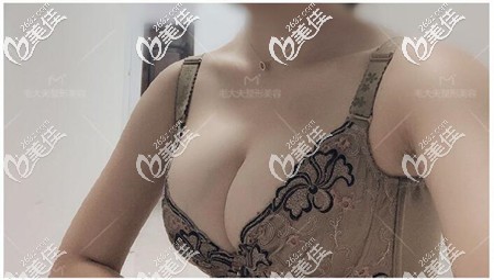 隆胸五年的感受說一說，平胸的我感覺250cc的假體有點小卻不后悔的原因