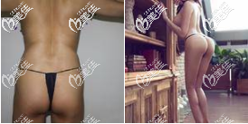 北京禾美嘉自體脂肪豐臀真人案例