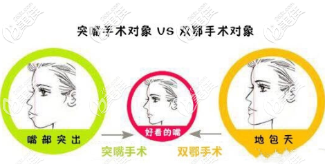 突嘴手術(shù)和雙鄂手術(shù)的區(qū)別 突嘴手術(shù)和雙鄂手術(shù)的區(qū)別