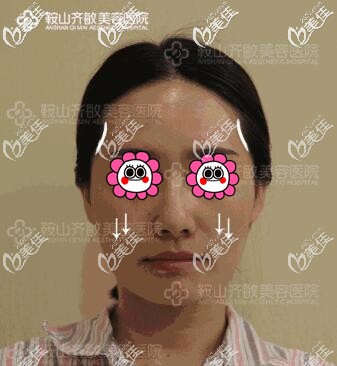 做自體脂肪填充全臉術(shù)前照 做自體脂肪填充全臉術(shù)前照