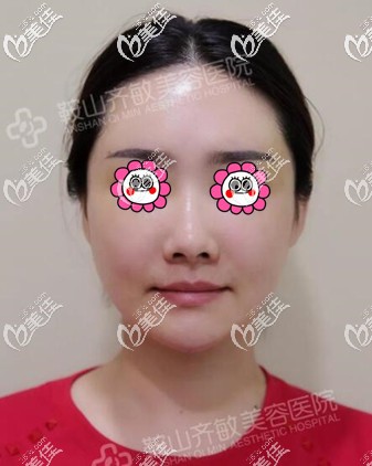 自體脂肪填充面部1個月時的<span style= 自體脂肪填充面部1個月時的<span style=