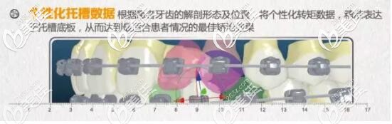 insignia精準正畸個性化托槽 insignia精準正畸個性化托槽