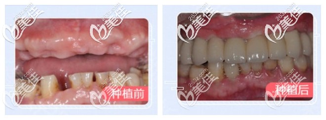 半口種植牙前后對比照 半口種植牙前后對比照