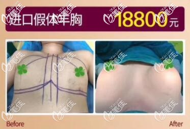 海南華美進(jìn)口假體豐胸真人前后對比效果圖