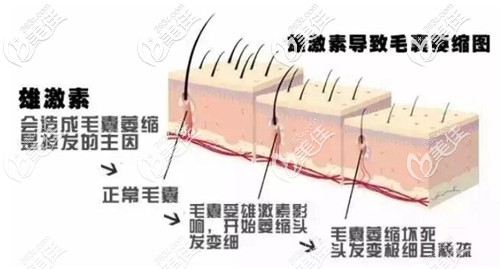 導(dǎo)致雄性脫發(fā)的主要原因 導(dǎo)致雄性脫發(fā)的主要原因