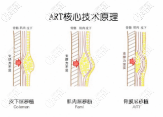 馮斌醫(yī)生的脂肪填充優(yōu)勢(shì)