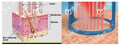 點(diǎn)陣激光祛疤的原理