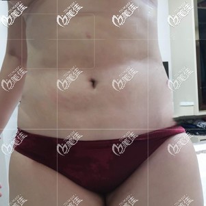 吸脂瘦腰腹術(shù)后25天效果