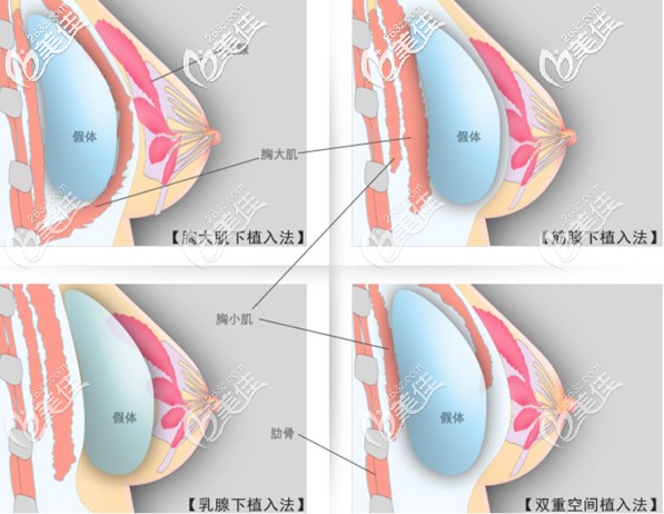 隆胸假體放置的層次