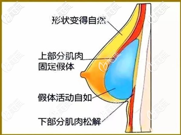 雙平面隆胸優(yōu)勢(shì)