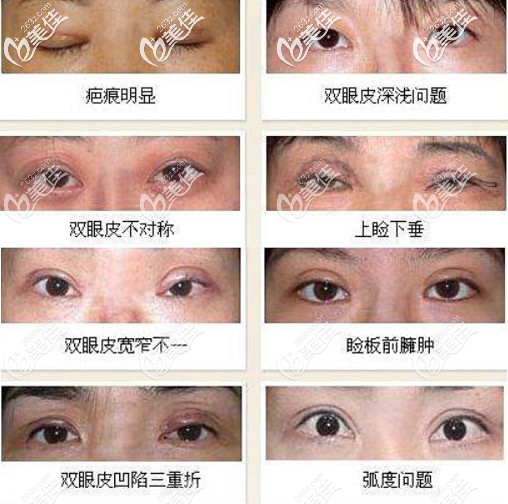 雙眼皮失敗的八種圖片 雙眼皮失敗的八種圖片