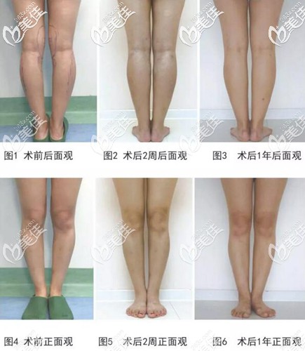 輕度膝內(nèi)翻畸形的手術(shù)方法 輕度膝內(nèi)翻畸形的手術(shù)方法