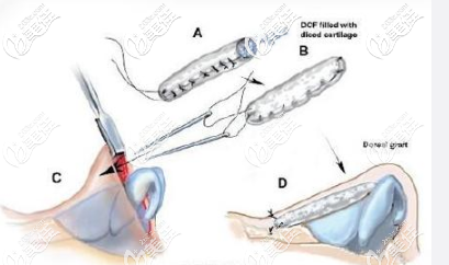 土耳其軟糖隆鼻手術(shù)原理