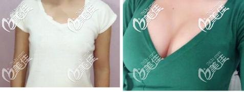 假體隆胸250高凸效果前后對比 假體隆胸250高凸效果前后對比