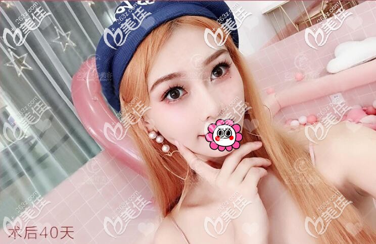 用雙眼皮貼時(shí)間久后會(huì)發(fā)現(xiàn)眼皮松弛，只好用全切雙眼皮來增大眼睛還真是個(gè)不錯(cuò)的選擇