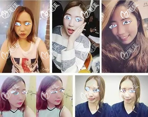 隆鼻手術(shù)前我這難看的大鼻頭 隆鼻手術(shù)前我這難看的大鼻頭