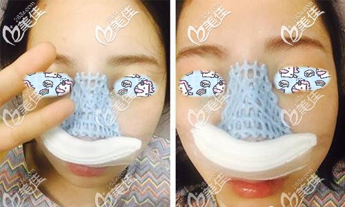 做完自體軟骨隆鼻手術(shù)后即刻 做完自體軟骨隆鼻手術(shù)后即刻