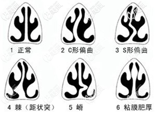 醫(yī)生給出常見的幾種鼻中隔偏曲類型 醫(yī)生給出常見的幾種鼻中隔偏曲類型