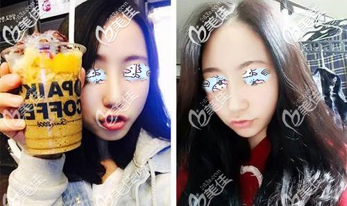 自體軟骨隆鼻術(shù)后30天腫脹漸消 自體軟骨隆鼻術(shù)后30天腫脹漸消