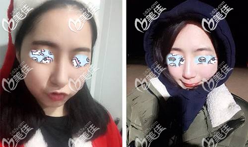 本以為是做了鼻綜合手術(shù)才導(dǎo)致出現(xiàn)了鼻炎，誰知道竟然是鼻中隔彎曲“搗的鬼”