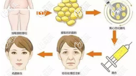 郭帥醫(yī)生做自體脂肪移植面部手術 郭帥醫(yī)生做自體脂肪移植面部手術