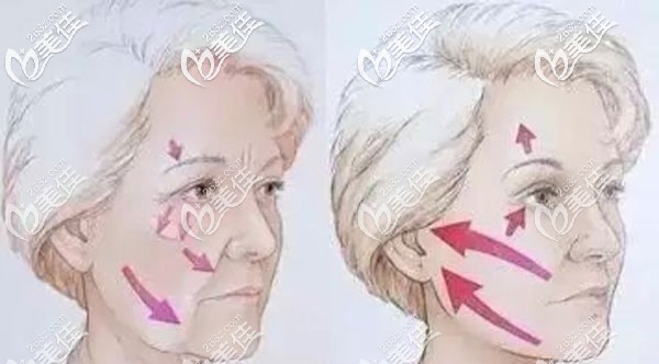 呂佳憶醫(yī)生在埋線提升方面的5大技術(shù)優(yōu)勢(shì)