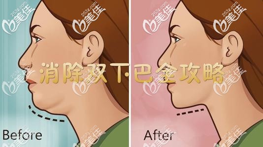 下頜骨發(fā)育不足有雙下巴 下頜骨發(fā)育不足有雙下巴