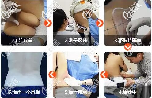 酷塑冷宮溶脂治療過程