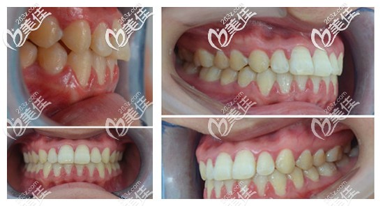 地包天矯正后會(huì)更丑？那是你沒看過(guò)她30歲帶ormco自鎖托槽牙套矯正后的效果
