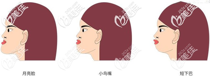 地包天又稱為月亮臉