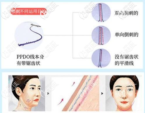 埋線提升的線材分為吸收和不可吸收