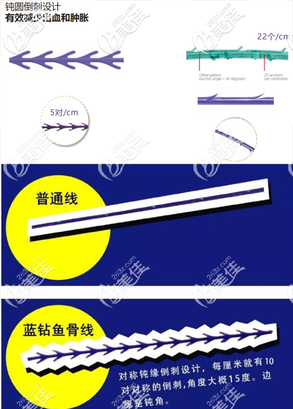 美國強(qiáng)生魚骨線的優(yōu)勢