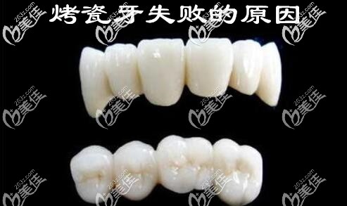 濰坊鄭氏口腔劉寶森講解烤瓷牙修復(fù)失敗的原因 濰坊鄭氏口腔劉寶森講解烤瓷牙修復(fù)失敗的原因