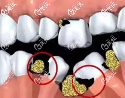 缺牙不種牙的危害