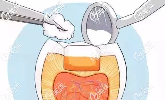 門牙用復(fù)合樹脂美學(xué)修復(fù)