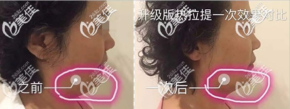 下頜緣做過一次熱拉提plus的效果 下頜緣做過一次熱拉提plus的效果
