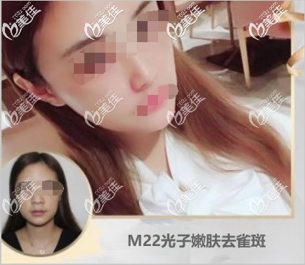 3次m22激光祛斑效果圖 3次m22激光祛斑效果圖