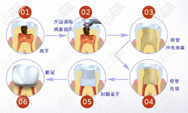 根管治療過(guò)程圖解